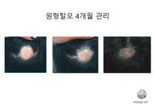 원형탈모 4개월 관리 후