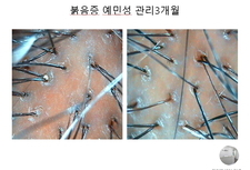 붉음증 예민성두피 3개월관리후기