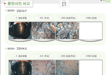 정수리탈모 관리 후기