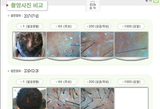 원형탈모 관리후기