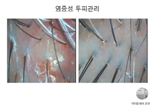여성두피 염증성두피 3개월관리후기 