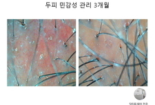 두피민감성 3개월 관리후기