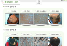 전두탈모(원형탈모) 8개월 관리 후기