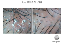 건선두피관리 2개월 관리후기