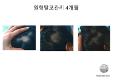 원형탈모관리 4개월