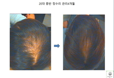 정수리 탈모관리 4개월 관리후기
