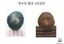 정수리탈모