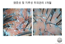 염증성 및 지루성 두피 3개월관리후기