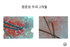 염증성 두피관리 2개월