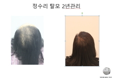여성 정수리 탈모관리