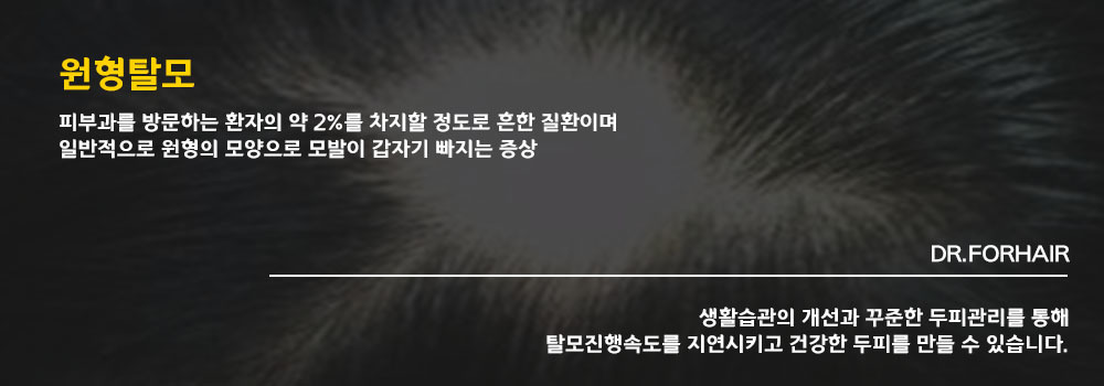 원형탈모설명
